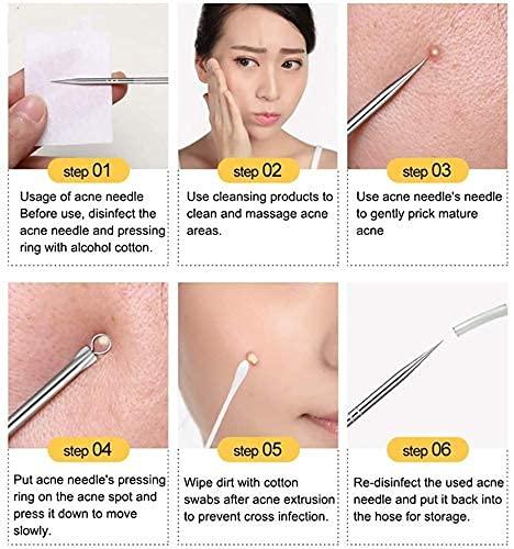 Stainless steel Blackhead Remover